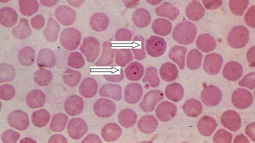 rozetovitě uspořádaných merozoitů. Napadené krvinky jsou zvětšené, odbarvené a s typickými bazofilními granuly (tzv. Schüffnerovo tečkování). Celý erytrocytární vývoj trvá 48 hodin.