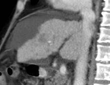 před ledvinou ligamentum