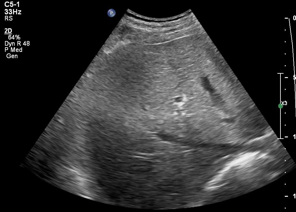 Játra na UZ Homogenní Echogenita stejná nebo jen mírně vyšší než kůra ledviny Hladký povrch, ostrý dolní okraj Spatial Compound Imaging + Tissue Harmonic Imaging zlepší kvalitu obrazu a hodnocení