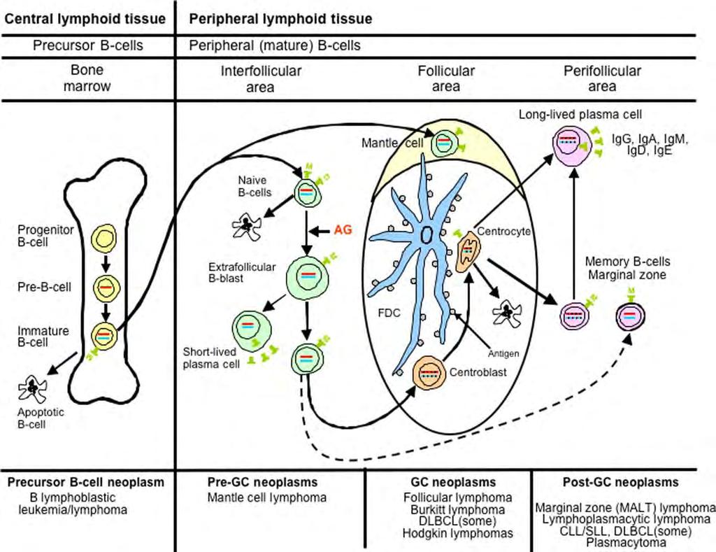 B LYMFOCYTY Classification of lymphoid neoplasms: the