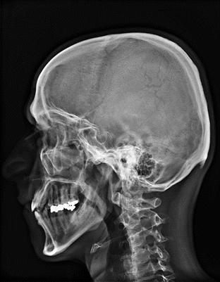 Rtg snímek hlavy Prostý snímek v boční projekci. Sinus frontalis. Squama ossis frontalis. Os parietale. Os occipitale + protuberantia occipitalis ext.. Orbita 8 9. Allae minores.
