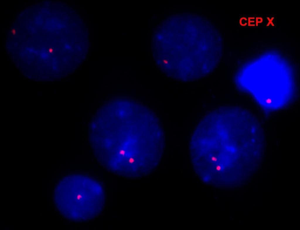 VROZENÉ CHROMOSOMOVÉ ABERACE (VCA) MOZAICISMUS - gonosomy 2 signály (přítomny 2 chromosomy X v jádře T-lymfocytu) 1 signál (přítomen 1 chromosom X v jádře buňky)