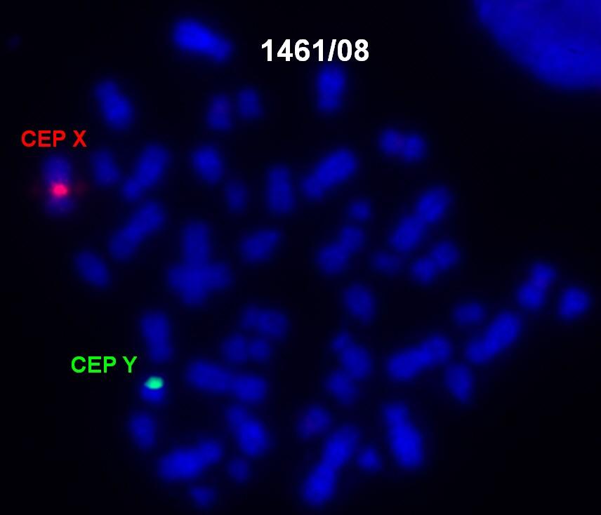 VROZENÉ CHROMOSOMOVÉ ABERACE (VCA) MOZAICISMUS