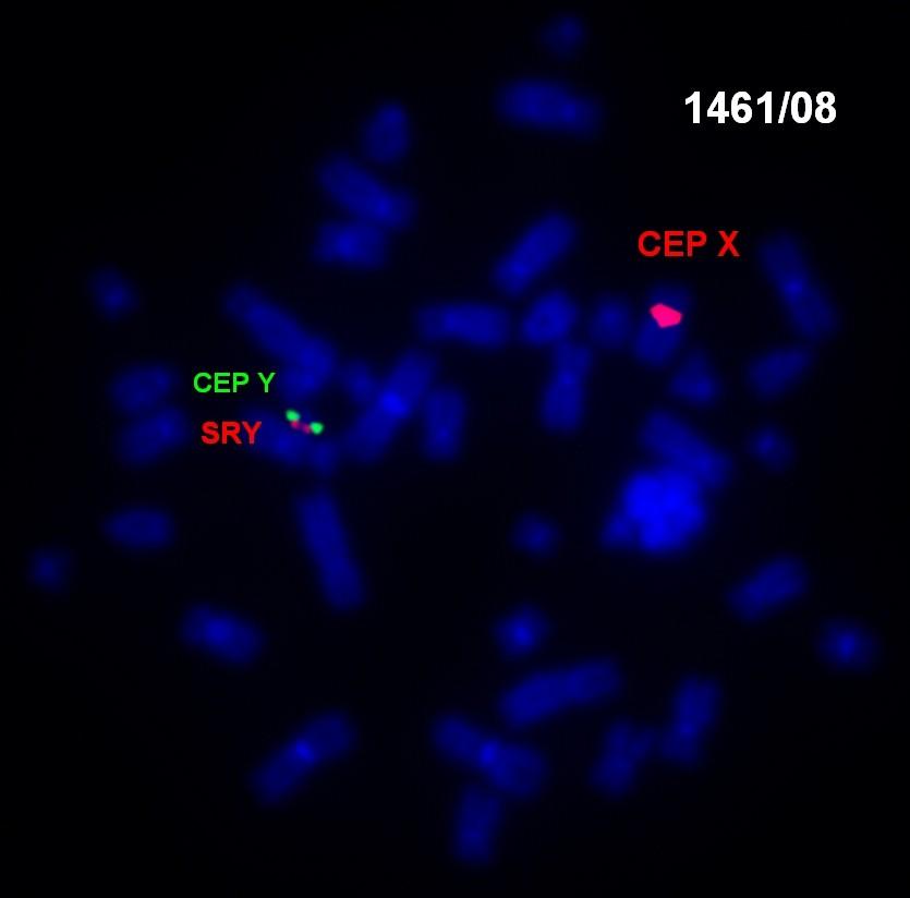 VROZENÉ CHROMOSOMOVÉ ABERACE (VCA) MOZAICISMUS