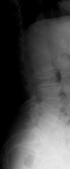 na miechu a durálny vak CT vyšetrenie informácia o štruktúre