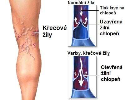 ENDOVENOZNÍ OPERACE VARIXŮ DOLNÍCH KONČETIN.