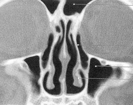 Na coronálním řezu CT na úrovní ductus nasolacrimalis je patrná i asymetrie spodiny lební sinus frontalis ductus nasolacrimalis sinus maxillaris dolní skořepa Ductus