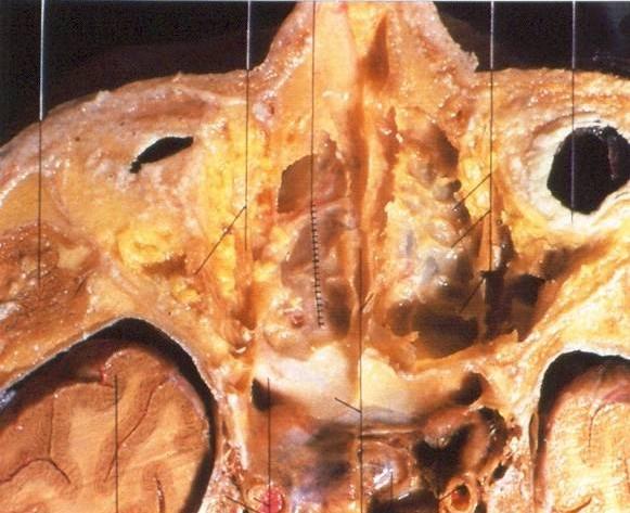 Pohled do stropu etmoidů a klínové dutiny m. rectus sup. et med. cellulae ethm. a. ethmoid. ant. et aa.