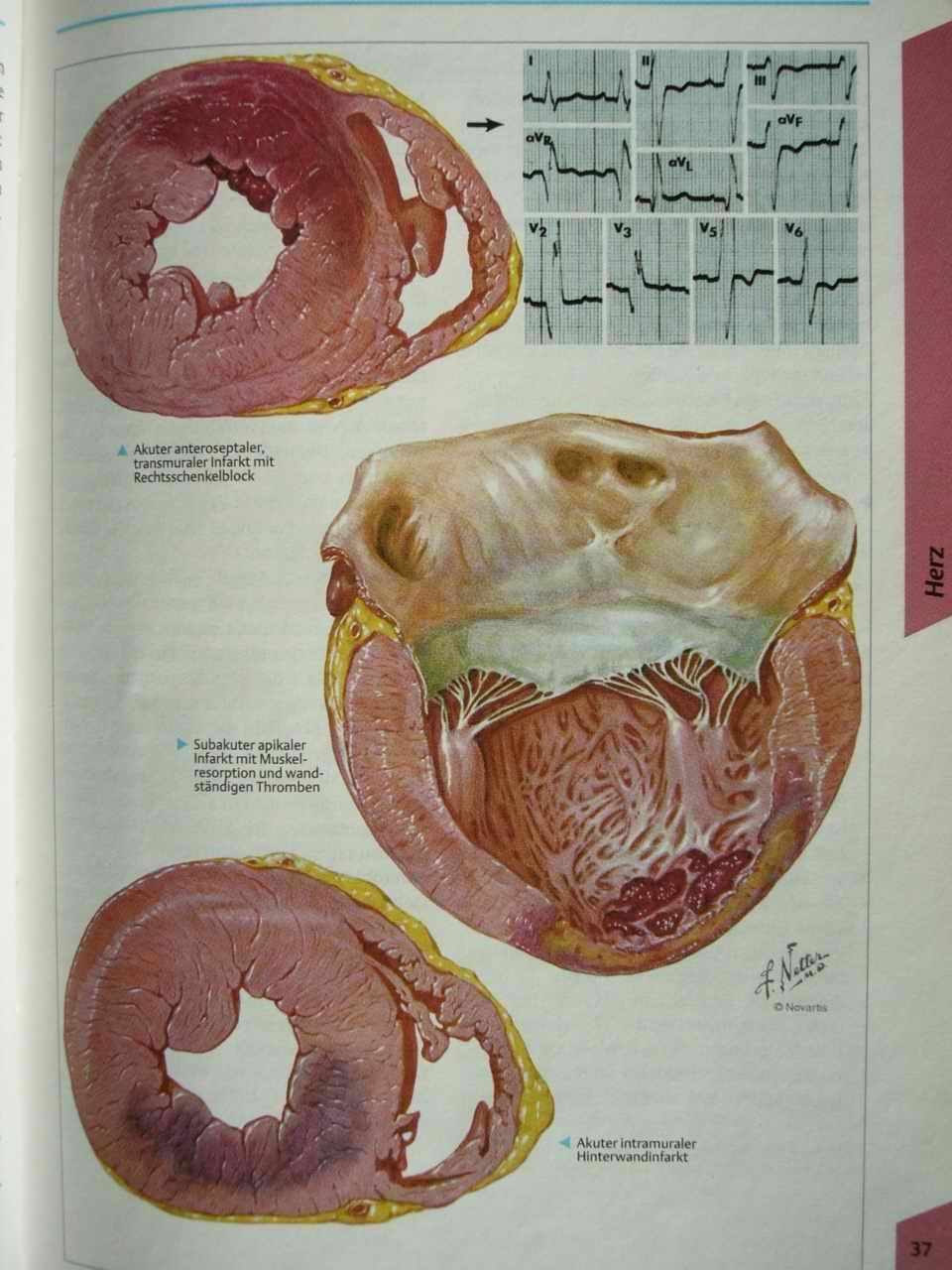 Infarkt