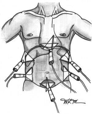 FAST Focused Assessment with Sonography in Trauma Indikace - penetrující a