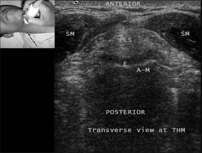 Airway Předpoklad obtížné intubace Velikost trach.