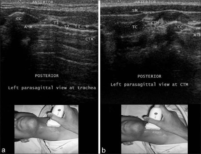 Airway Předpoklad obtížné intubace Velikost trach.