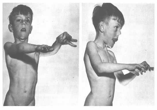 SYDENHAM S CHOREA Principal Pathologic Lesion: Corpus Striatum Clinical Feature - Complication of Rheumatic Fever - Fine, disorganized, and random movements of extremities,