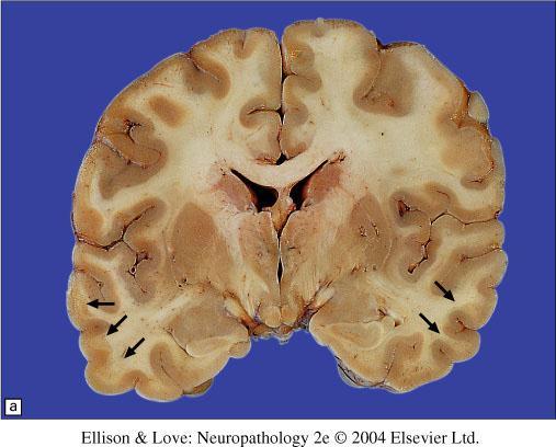 ODS = Osmotický demyelinizační syndrom = Syndrom centrální pontinní a extrapotinní myelinolýzy ložiskový rozpad myelinu centrální část pontu (typická lokalizace) thalamus corpora striata corpus