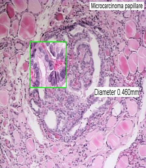 KARCINOMY ŠTÍTNÉ ŽLÁZY - folikulární - vaskulární a kapsulární invaze - metastázy - plíce, kosti; LU - papilární - dg. matnicová jádra - metastázy lymfatickou cestou - reg.