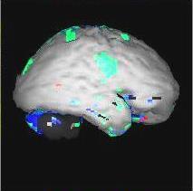 Perfuzní SPECT mozku (Single-Photon Emission Computer Tomography) DISTRIBUCE REGIONÁLNÍHO PRŮTOKU MOZKEM SPECT lokální snížení průtoků