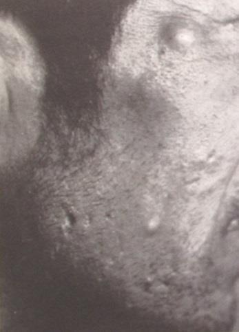 1965-1968 80 osob onemocnělo, 55 osob sledováno 100 % acne chlorina 50 % hyperlipidémie 38 % osob polyneuropatie 20 %