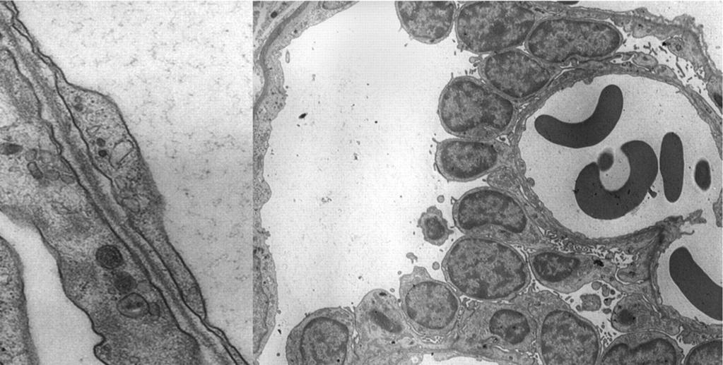 Bazální membrána Defekt β2 řetězce lamininu Piersonův