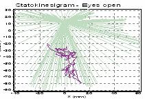 Obr. 8 Porovnání statokineziogramu - záznamu trajektorie COP při stoji s otevřenýma očima (Ia) a stoji s otevřenýma očima při plnění Dotykového testu (IIa).