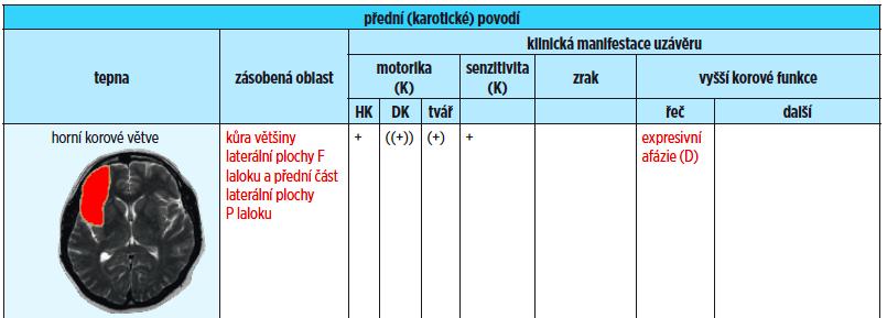 M2 horní korové větve (Superior) Vzácnější, ale rozsáhlá léze Faciobrachiální převaha, hemineglect vizuální bez