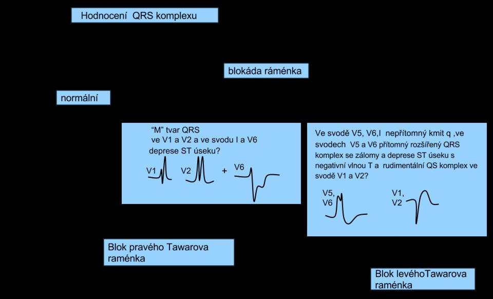 Pokud je QRS komplex prodloužen nad hodnotu 0,12s jedná se o blokádu jednoho z Tawarových ramének (v pokročilejších hodnoceních se potom hodnotí částečná nebo úplná).