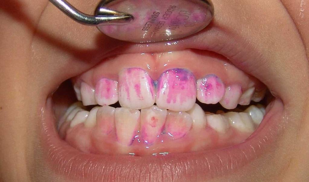 Orální biofilm zubní plak Pokus: Dobrovolník má připravenou tabletku s.barvivem barvícím zubní plak.