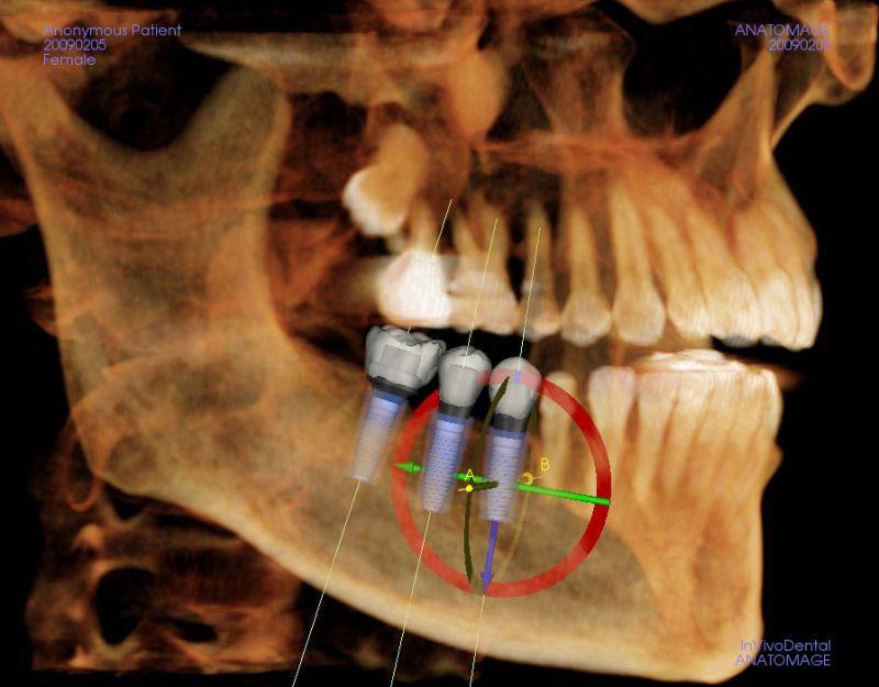 10.4.1 Zmapování nabídky alveolární kosti Snímkem z ortopantomogramu získáme přehledný obraz o stavu alveolárních výběžků, poloze mandibulárního kanálu s foramen mentale, zubů,