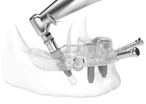 10.4.2 Naplánování implantace a surakonstrukce V této fázi se zaměříme na výběr vhodného implantátu pro daný případ.