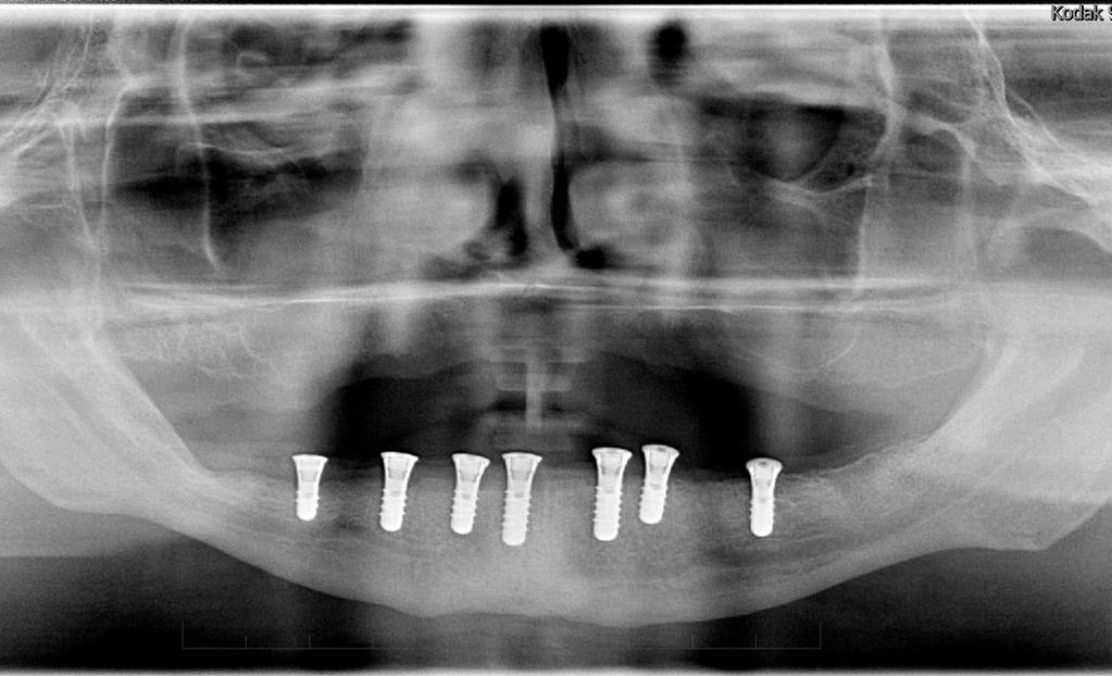 implantátů Rentgenový snímek dolní