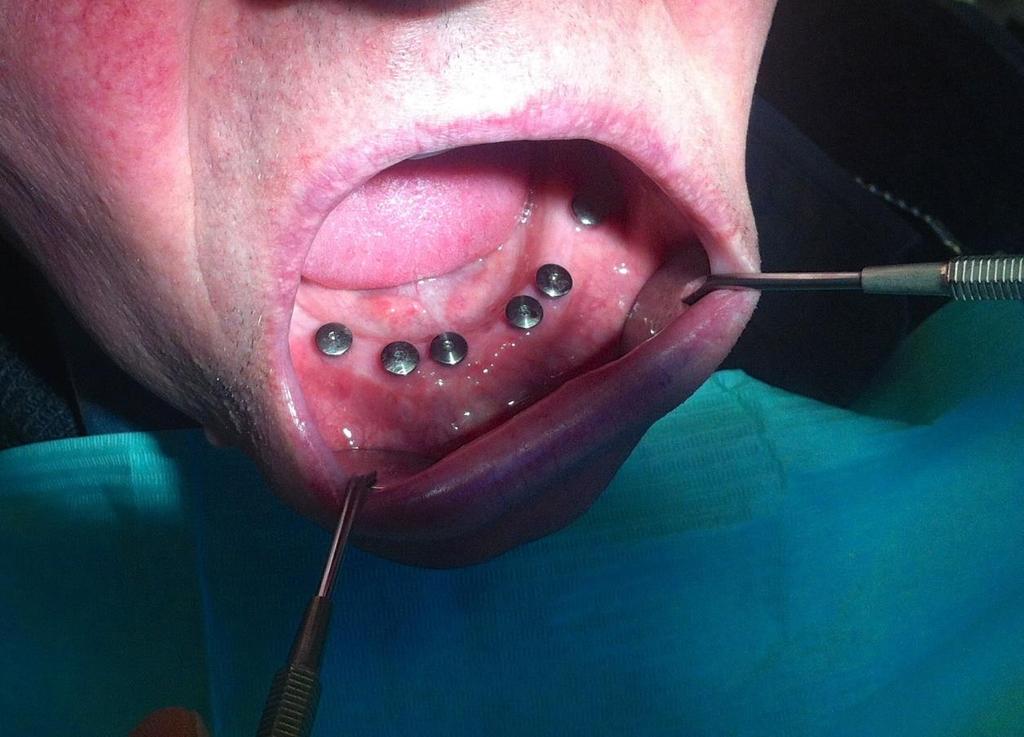 Situace v ústech pacienta s implantáty