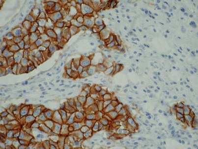 amplifikace genu Incidence celosvětová: 10-25% evropská: 17% česká: 14,2% (ročně cca 700-800 pacientek) Yang-Feng et al. Cytogenet. Cell Genet.