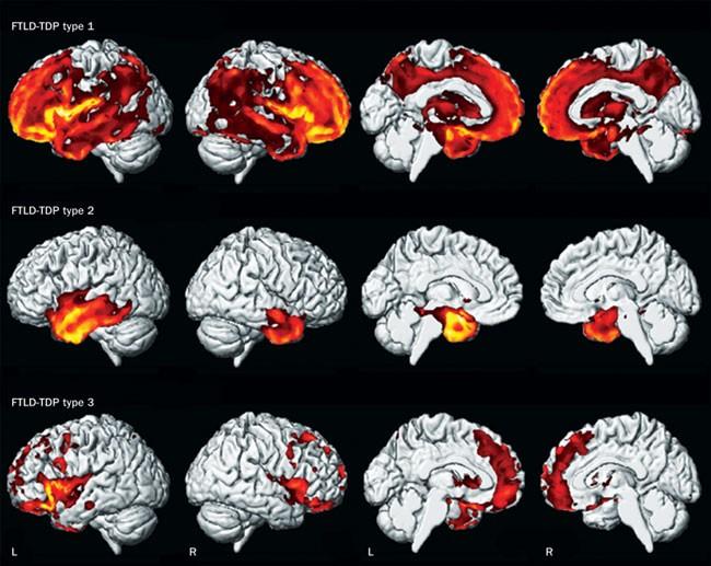 Klinická NeuroPsy paměti - FTLD Frontotemporální lobární degenerace Narušení exekutivních