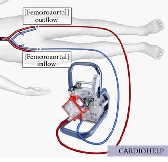 high risk PCI RFA