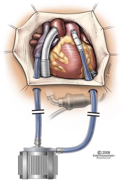 CentriMag RVAD