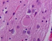 Patofyziologie PSP Tauopatie (tau pozitivní gliální inkluze) dominantní postižením mesencefala, bazálních ganglií a pontu