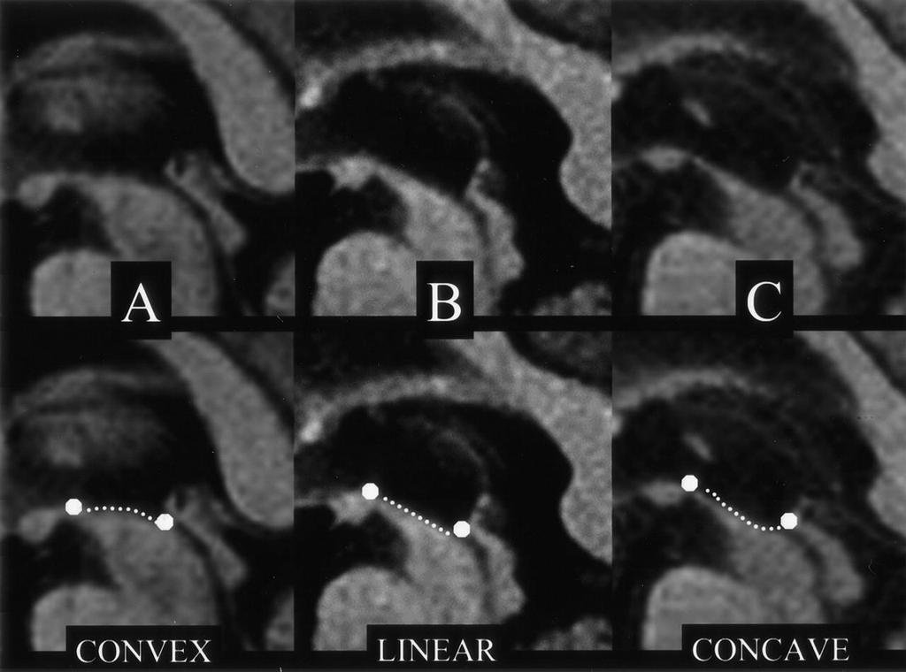 MRI PSP Brain Stories,