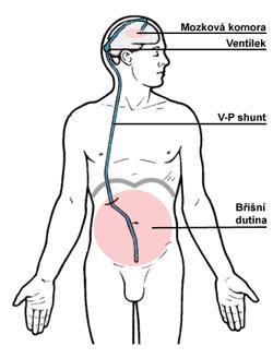 Normotenzní hydrocefalus (NPH) klinická trias Diagnostika: CT, MRI- rozšíření postranních