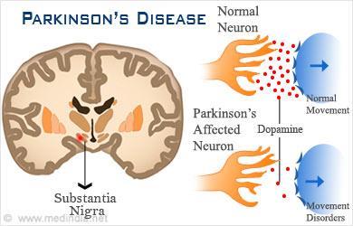 PARKINSONOVA NEMOC Autor: Jáňová Anetta Výskyt Parkinsonova nemoc (PN) je chronické, pomalu se rozvíjející neurodegenerativní onemocnění. Nemoc nelze vyléčit, lze ji však léčit, tj.