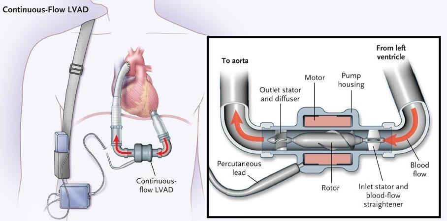 LVAD mechanické srdeční náhrady Heart