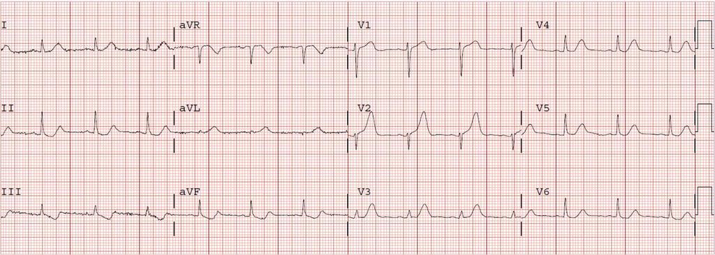 NSTEMI