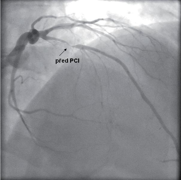 PCI