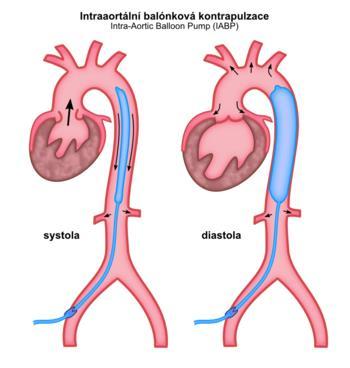 IABP Intraaortální