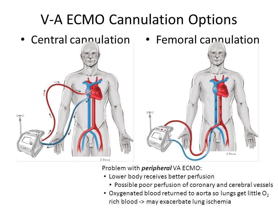 ECMO