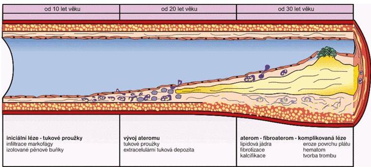 Patofyziologie AIM podkladem je u více než 2/3 ruptura nestabilního koronárního plátu