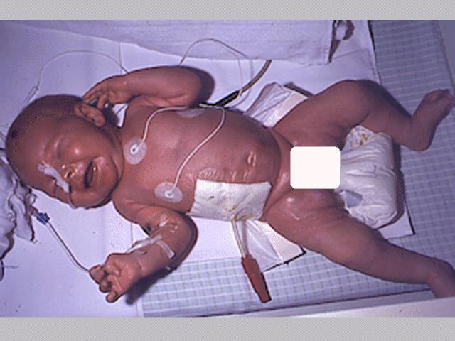 Akutní nemoc novorozence s bezvědomím/ataky poruch vědomí