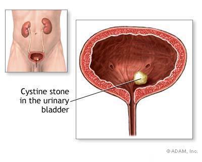 Urolithiasa http://www.nature.