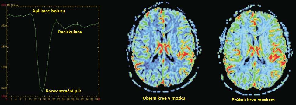 [18]. Obrázek 15: Schéma získání perfuzních map metodou DSC [18] Podmínkou je ale neporušená hematoencefalická membrána.