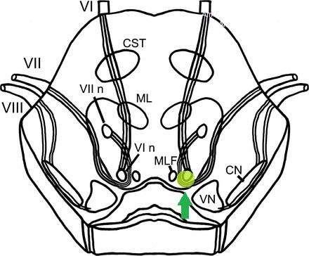 oškozeno jádro n. VI. a vlákna VII. N. (genu internum) syndrom colliculus n. facialis ombinace příznaků obrny n. facialis a n.