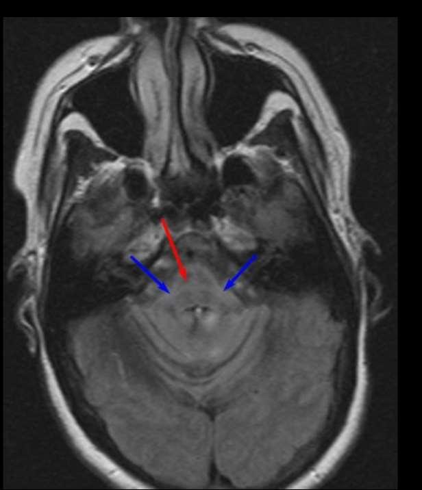 T2 W MR horizontální řez hot cross bun sign in the pons kříž uprostřed pontu selective loss of myelinated transverse pontocerebellar fibers and neurons in the pontine raphe, with