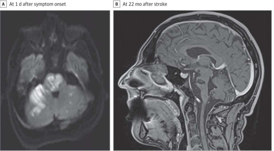 Locked in syndrom - Syndrom uzamčení Poškození kmene Quarduparesa, Obrny hlavových nervů Možné jen mrkání Vědomí zachováno Recovery From Locked-in Syndrome Sara Hocker, MD 1 ; Eelco F. M. Wijdicks, MD, PhD JAMA Neurol.